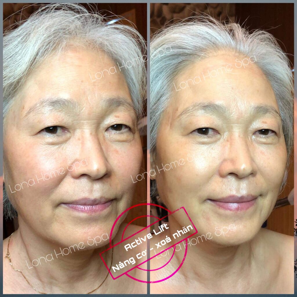 Những cải tiến công nghệ tiên tiến giúp bác sĩ da liễu ở Long Xuyên điều trị hiệu quả, khiến cho mỗi địa chỉ khám da liễu Long Xuyên tự hào khi có bác sĩ da liễu giỏi Long Xuyên chăm sóc bệnh nhân.