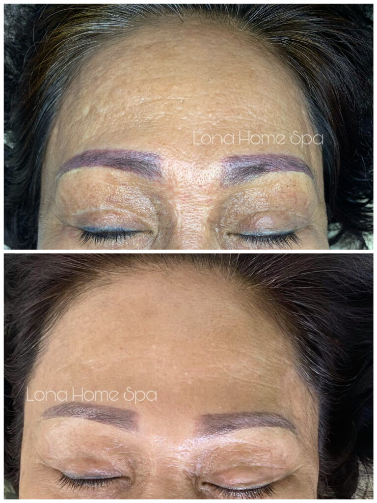 Hình ảnh trước và sau điều trị da, thể hiện khả năng của bác sĩ da liễu giỏi Bạc Liêu và khám da liễu Bạc Liêu, đồng thời là địa chỉ bác sĩ da liễu Bạc Liêu được khuyến nghị tại phòng khám da liễu Bạc Liêu.