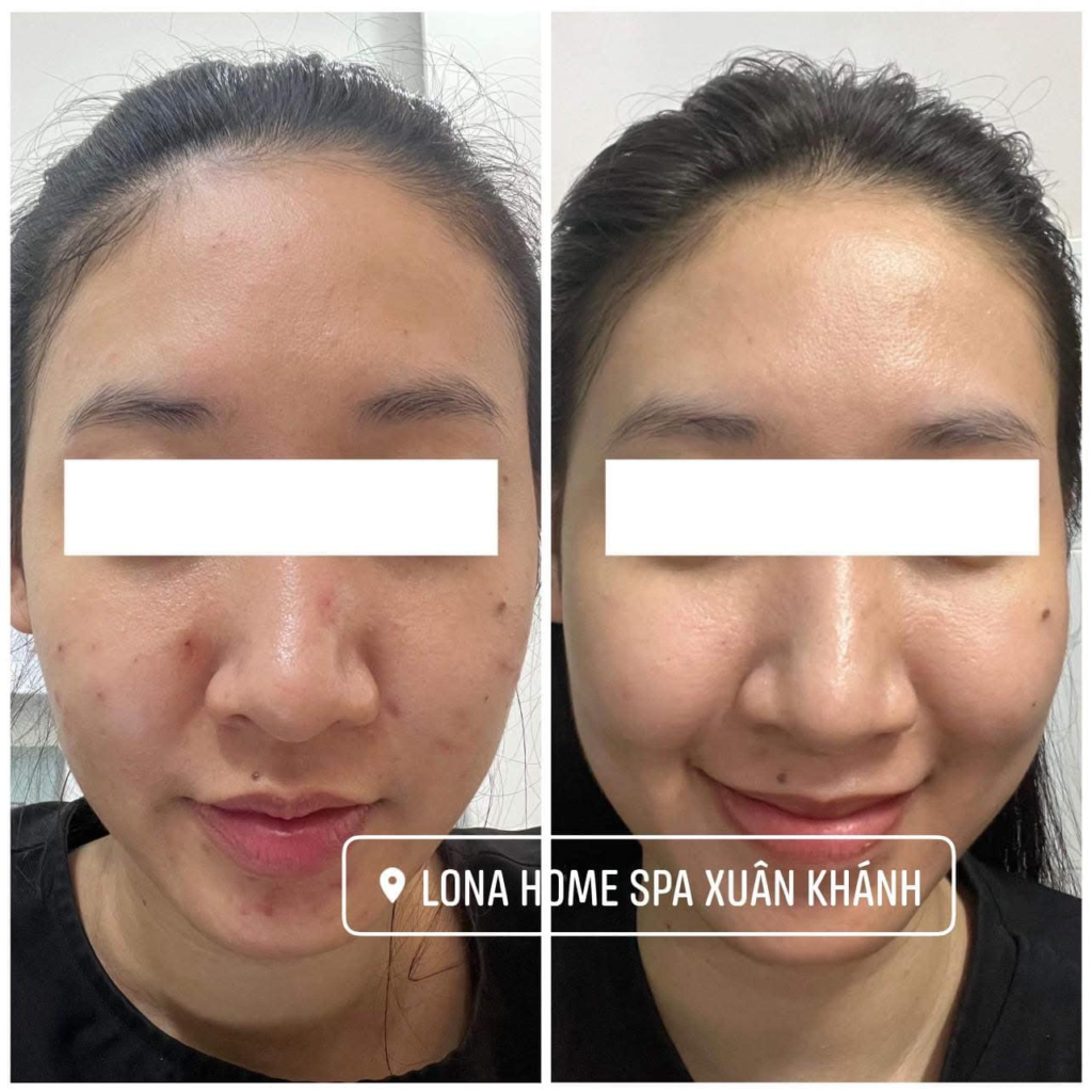 Quy trình tiêm meso Vĩnh Long tiên tiến đã giúp nhiều khách hàng trải nghiệm dịch vụ mesotherapy Vĩnh Long, đồng thời nhận được đánh giá tiêm meso Vĩnh Long cao từ thẩm mỹ viện Vĩnh Long về hiệu quả trẻ hóa da Vĩnh Long.