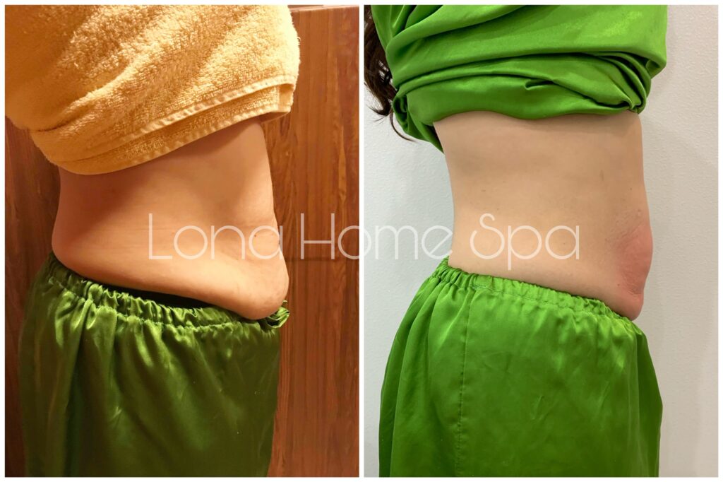 Hình ảnh trước sau của liệu trình giảm béo cho thấy kết quả giảm béo ấn tượng, mang lại phom dáng thon gọn và tự tin.