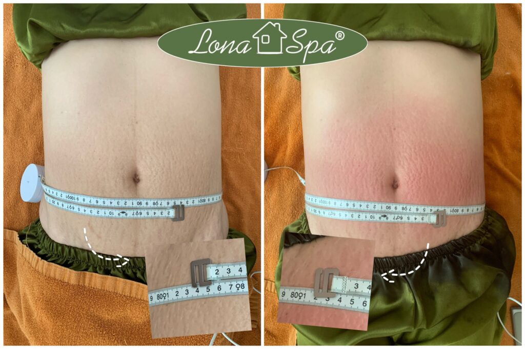 Hình ảnh giảm mỡ qua phương pháp massage và liệu pháp chuyên sâu, giúp giảm mỡ và tạo vòng eo thon gọn.
