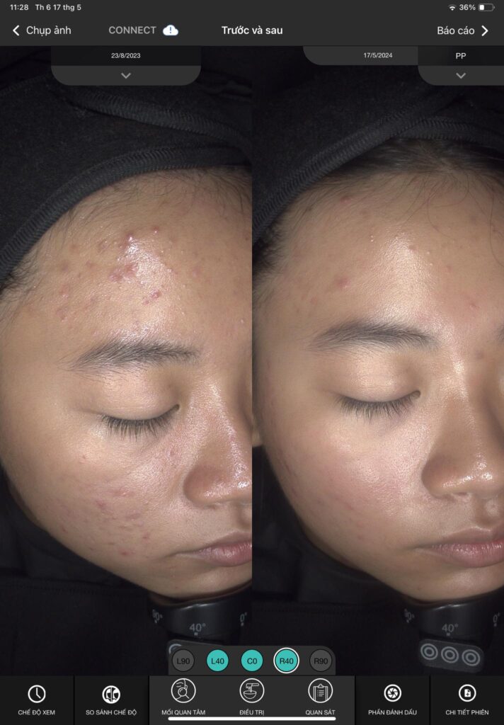 Qua hình ảnh, khách hàng có thể cảm nhận được sự chuyên môn của spa trị mụn Đồng Tháp, chứng tỏ spa trị mụn tốt nhất Đồng Tháp và spa uy tín tại Đồng Tháp luôn tiên phong trong việc điều trị mụn tại spa Đồng Tháp, đồng thời mang lại dịch vụ trị mụn Đồng Tháp tối ưu cho làn da.