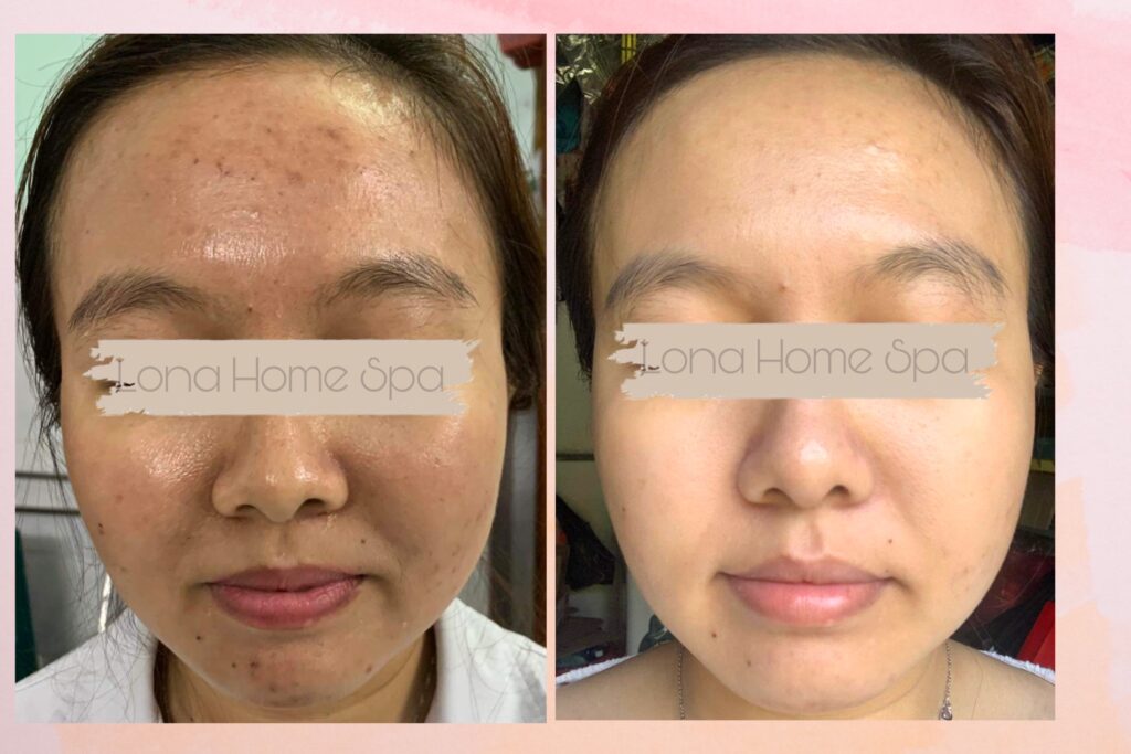 Hình ảnh thể hiện thành quả điều trị rõ rệt tại spa trị mụn Đồng Tháp, khi spa trị mụn tốt nhất Đồng Tháp, spa uy tín tại Đồng Tháp áp dụng kỹ thuật hiện đại trong điều trị mụn tại spa Đồng Tháp và dịch vụ trị mụn Đồng Tháp mang lại hiệu quả vượt trội.