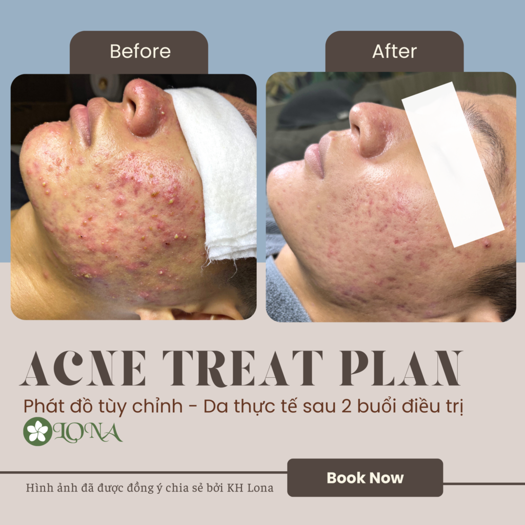 Bức ảnh minh họa quá trình chăm sóc chuyên sâu tại spa trị mụn Đồng Tháp, nơi spa trị mụn tốt nhất Đồng Tháp cùng với đội ngũ chuyên gia của spa uy tín tại Đồng Tháp áp dụng phương pháp điều trị mụn tại spa Đồng Tháp hiệu quả và dịch vụ trị mụn Đồng Tháp toàn diện.