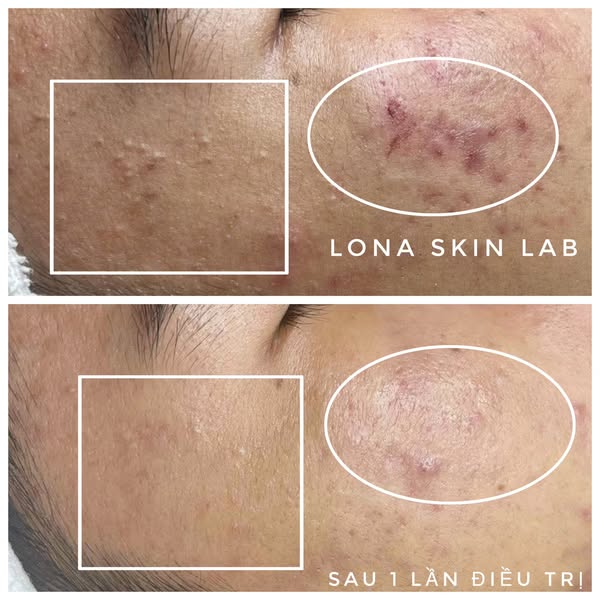 Hình ảnh này thể hiện sự tận tâm trong chăm sóc khách hàng tại spa trị mụn Đồng Tháp, nơi được công nhận là spa trị mụn tốt nhất Đồng Tháp với uy tín của spa uy tín tại Đồng Tháp trong việc điều trị mụn tại spa Đồng Tháp và mang đến dịch vụ trị mụn Đồng Tháp chất lượng cao.
