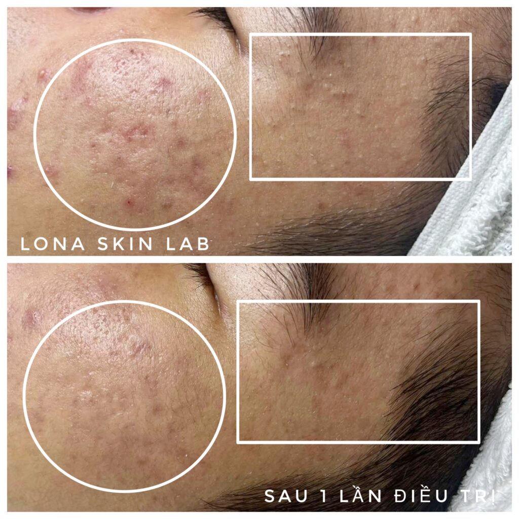 Bức ảnh này cho thấy những cải tiến đáng kể sau liệu trình, minh chứng cho hiệu quả của spa trị mụn hiệu quả Bến Tre và sự an toàn của các giải pháp được áp dụng tại spa trị mụn uy tín Bến Tre, mang lại làn da khỏe mạnh.