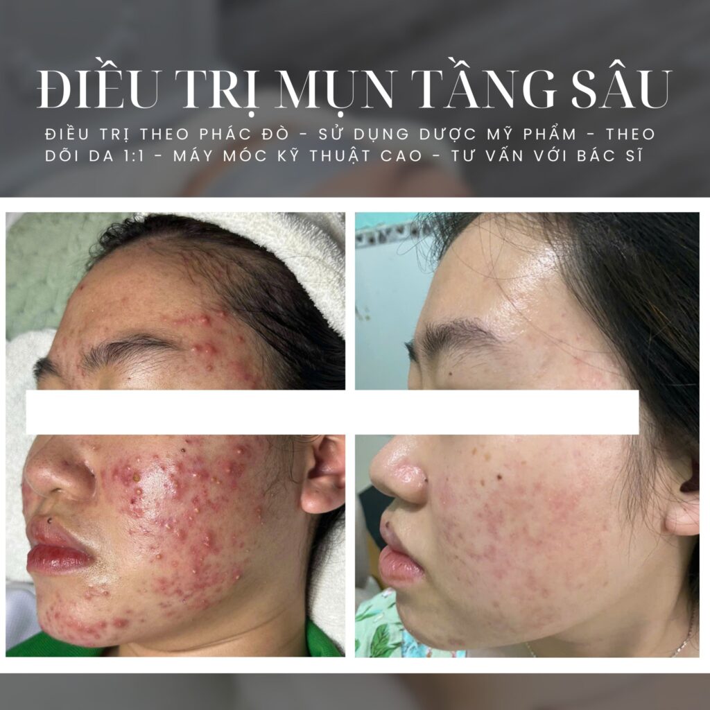 Với minh chứng từ hình ảnh sau điều trị, liệu trình được thực hiện tại spa trị mụn tốt nhất Bến Tre không chỉ cải thiện kết cấu da mà còn chứng tỏ sức mạnh của spa trị mụn giá rẻ Bến Tre trong việc duy trì làn da sạch mụn.