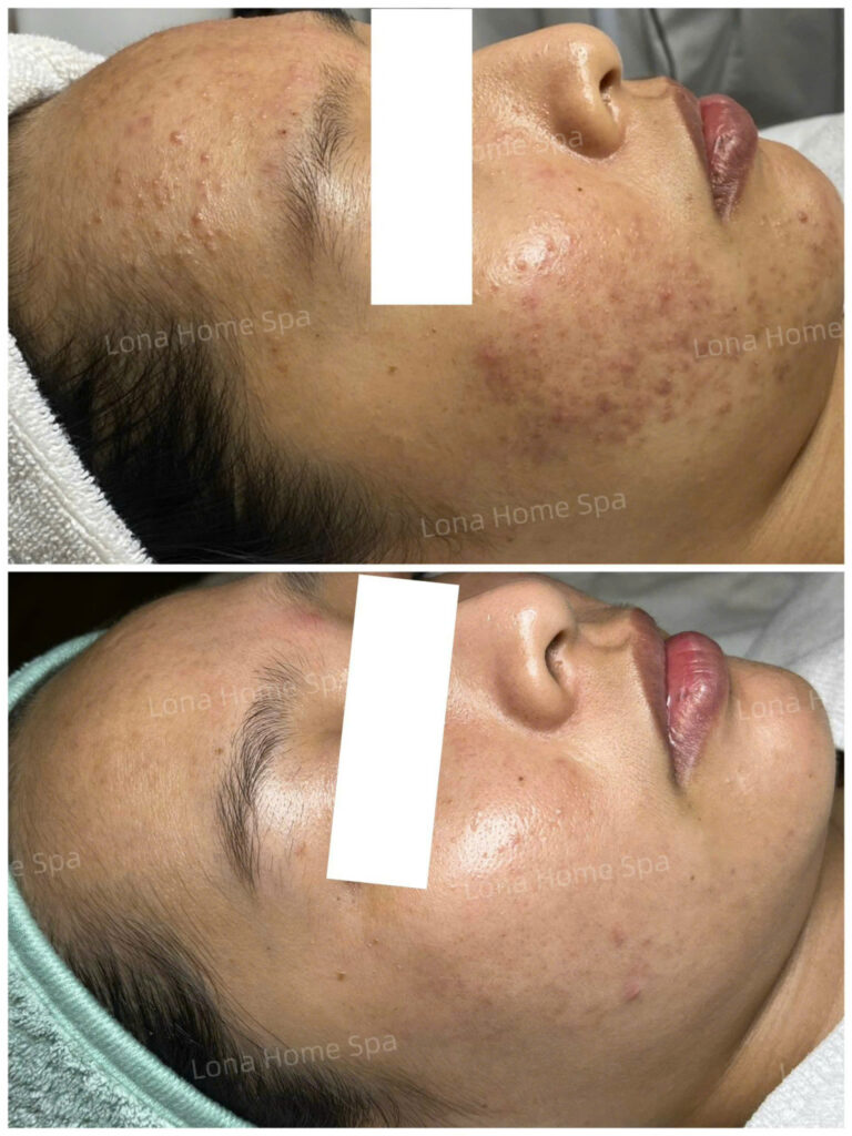 Kết quả từ bức ảnh cho thấy sự thay đổi rõ rệt trong chất lượng da của khách hàng, khẳng định giá trị của spa trị mụn Bến Tre khi kết hợp liệu pháp hiện đại giúp phục hồi và tái tạo da một cách toàn diện.