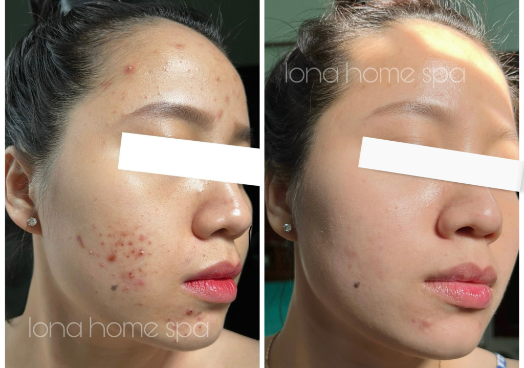 Hình ảnh cho thấy quy trình tỉ mỉ của spa trị mụn Đồng Tháp, nơi mà spa trị mụn tốt nhất Đồng Tháp và spa uy tín tại Đồng Tháp đã cung cấp những liệu trình điều trị mụn tại spa Đồng Tháp tiên tiến, cùng với việc đảm bảo dịch vụ trị mụn Đồng Tháp an toàn và hiệu quả.