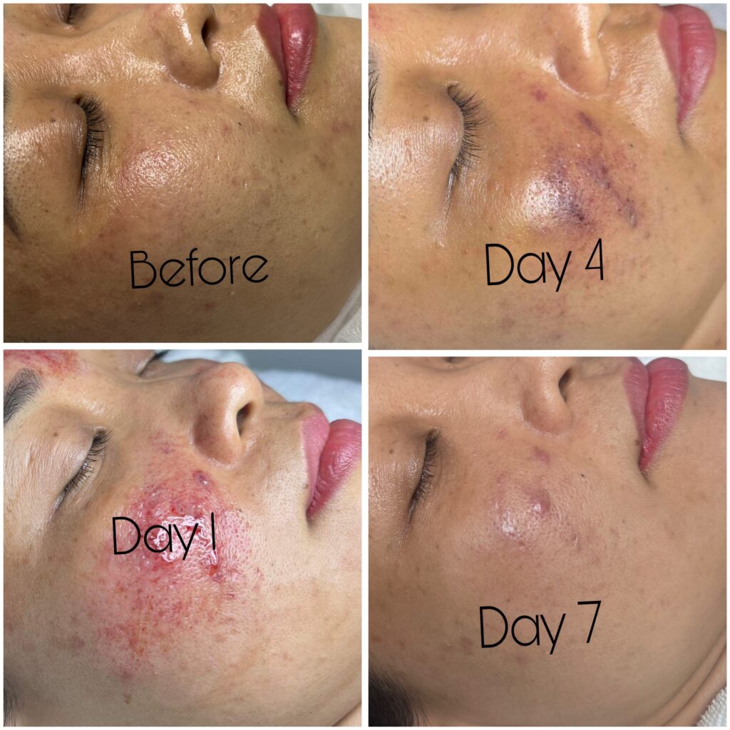 Hình ảnh cuối cùng khẳng định rằng phi kim trị sẹo rỗ tại Cần Thơ, với sự hướng dẫn tận tâm của chuyên gia Lona, là giải pháp trị sẹo rỗ tiên tiến nhất để điều trị sẹo rỗ hiệu quả trên làn da.