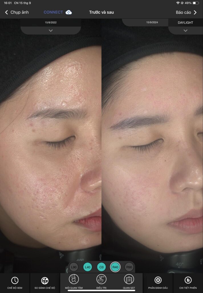Phương pháp trị sẹo mụn sử dụng công nghệ tiên tiến cho phép loại bỏ hàng loạt vết sẹo mụn, giúp quá trình trị sẹo mụn diễn ra an toàn và nhanh chóng.