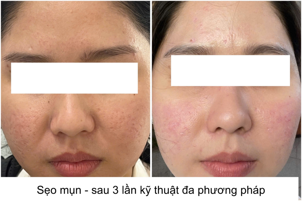 Liệu pháp trị sẹo mụn kết hợp nhiều bước chăm sóc da đã được hiện thực qua các hình ảnh minh họa, khẳng định hiệu quả trị sẹo mụn thông qua sự cải thiện rõ rệt về bề mặt da.