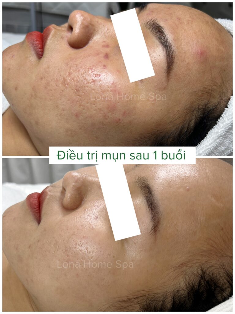 Quá trình trị sẹo mụn với liệu pháp kết hợp điều trị chuyên sâu đã chứng minh khả năng làm mờ vết sẹo do mụn, đồng thời nâng cao hiệu quả trị sẹo mụn qua từng liệu trình.