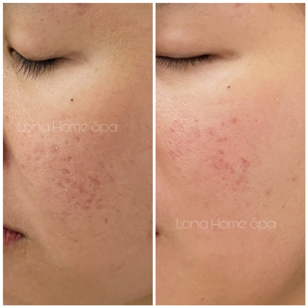 Bức ảnh trước và sau điều trị minh chứng rõ rệt từ phi kim trị sẹo rỗ tại Cần Thơ, nơi chuyên gia Lona áp dụng phi kim trị sẹo rỗ để triển khai giải pháp trị sẹo rỗ mang lại hiệu quả điều trị sẹo rỗ.