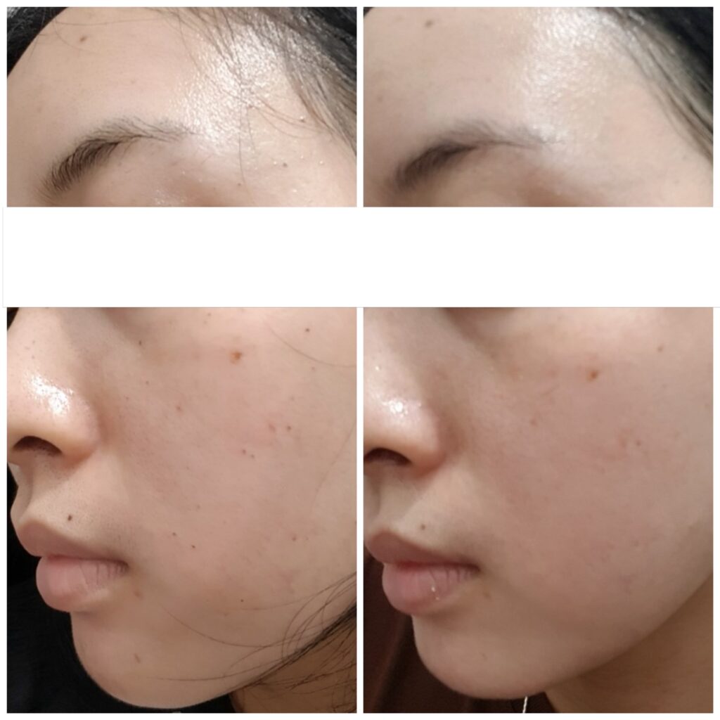 Hình ảnh trước và sau thể hiện kết quả ấn tượng của trị tàn nhang, giúp cải thiện các vết nám và tàn nhang trên da một cách rõ rệt.
