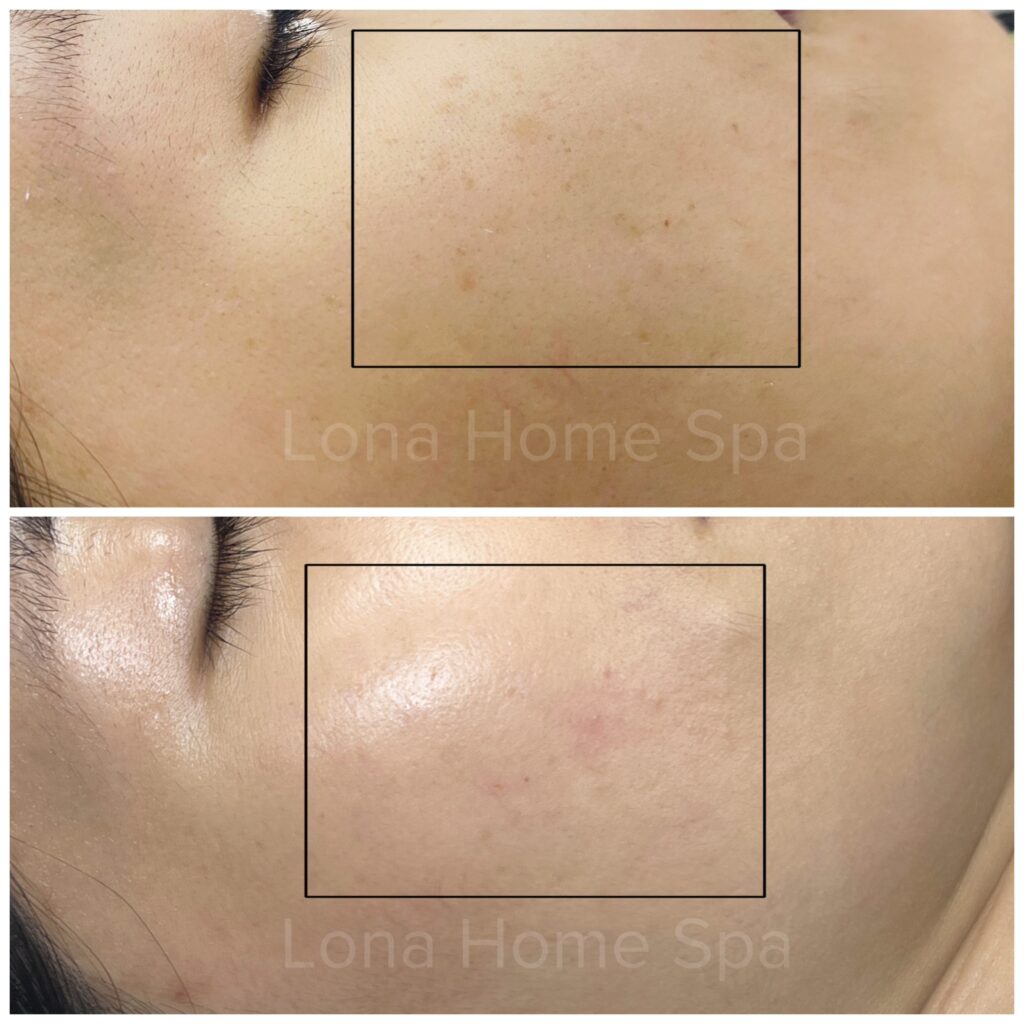 Phương pháp trị tàn nhang tiên tiến đã được ứng dụng thành công, giúp làm mờ các vết tàn nhang và đồng nhất màu da một cách tự nhiên.