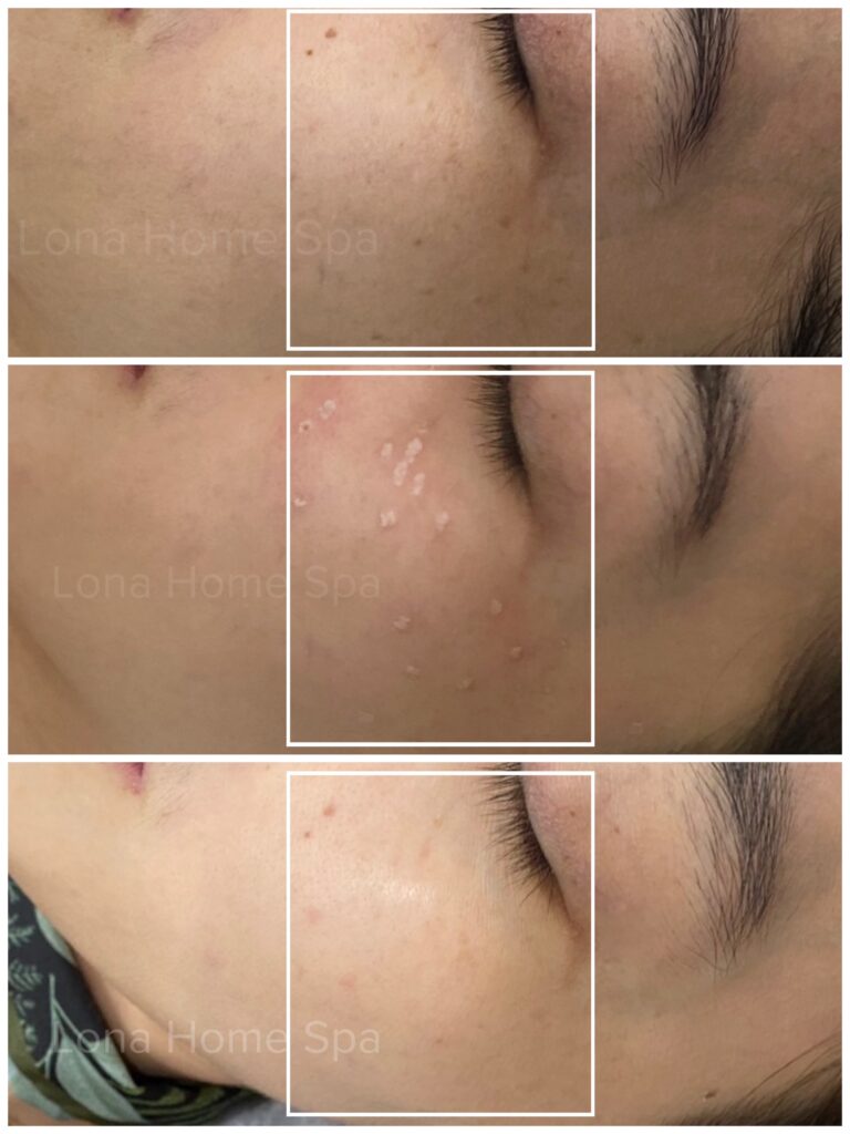 Kết quả ấn tượng từ trị nám Kiên Giang, cho thấy quá trình điều trị nám da Kiên Giang với sự hỗ trợ của công nghệ trị nám Kiên Giang tiên tiến và uy tín từ thẩm mỹ viện trị nám Kiên Giang cũng như spa trị nám Rạch Giá.