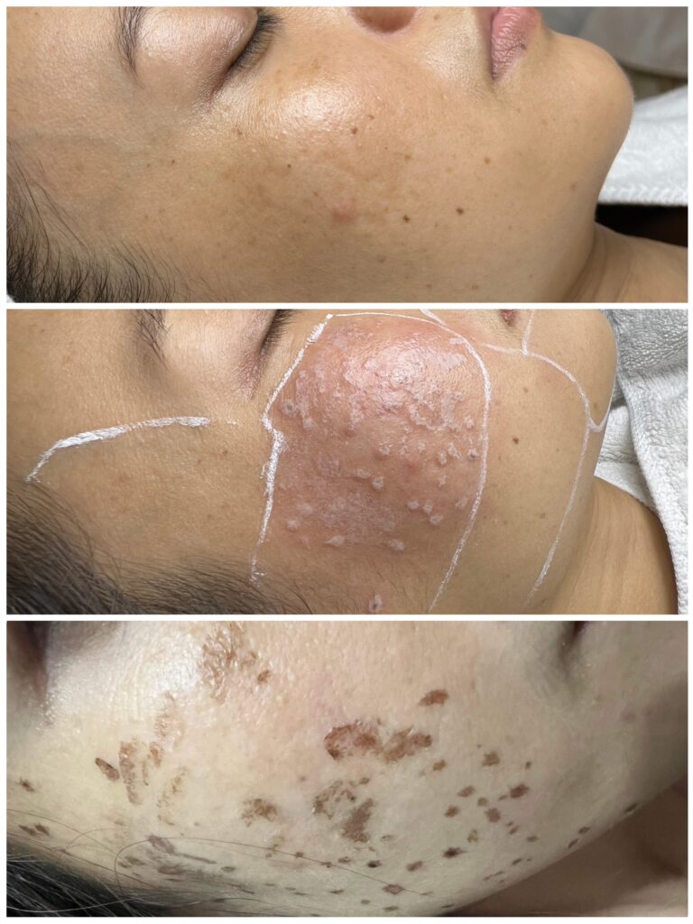 Hình ảnh trước-sau quá trình trị nám Kiên Giang, được thực hiện tại thẩm mỹ viện trị nám Kiên Giang với công nghệ trị nám Kiên Giang tiên tiến; liệu trình điều trị nám da Kiên Giang và spa trị nám Rạch Giá góp phần khôi phục làn da tươi trẻ.