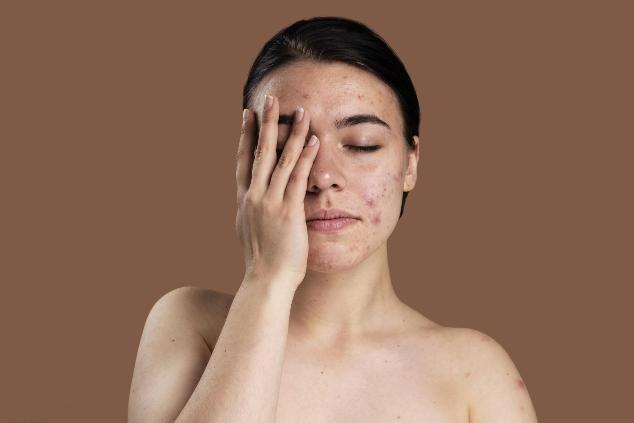 Hình ảnh trình bày các tình trạng mụn trên da nhờn với tuyến bã nhờn hoạt động quá mức, nhấn mạnh sự cần thiết của liệu trình điều trị da nhờn chuyên sâu.