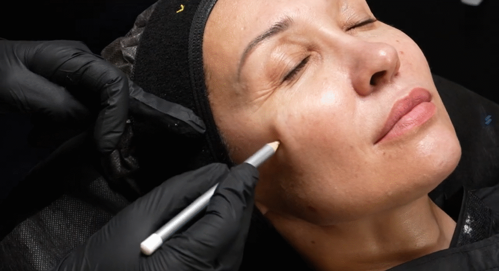 Bức ảnh thể hiện quá trình xác định vùng điều trị an toàn, minh chứng cho kinh nghiệm của bác sĩ da liễu ở Đồng Tháp; bác sĩ da liễu Đồng Tháp cùng phòng khám da liễu Đồng Tháp và bệnh viện da liễu Đồng Tháp luôn hướng tới việc chữa bệnh da liễu Đồng Tháp hiệu quả qua dịch vụ da liễu Đồng Tháp tiên tiến. 