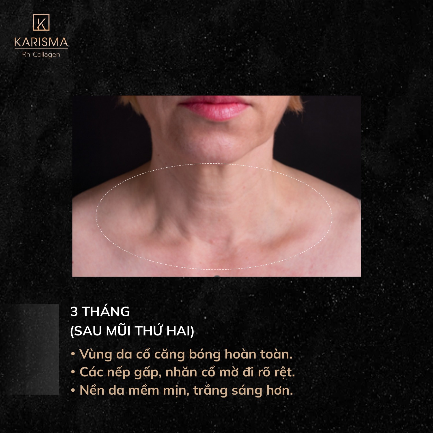 Karisma Rh Collagen xóa nhăn vùng cổ