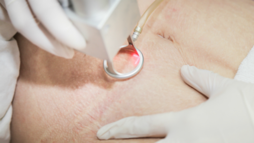Trị nám da tại cần thơ với Laser co2 fractional giúp điều trị nám da tại cần thơ hiệu quả