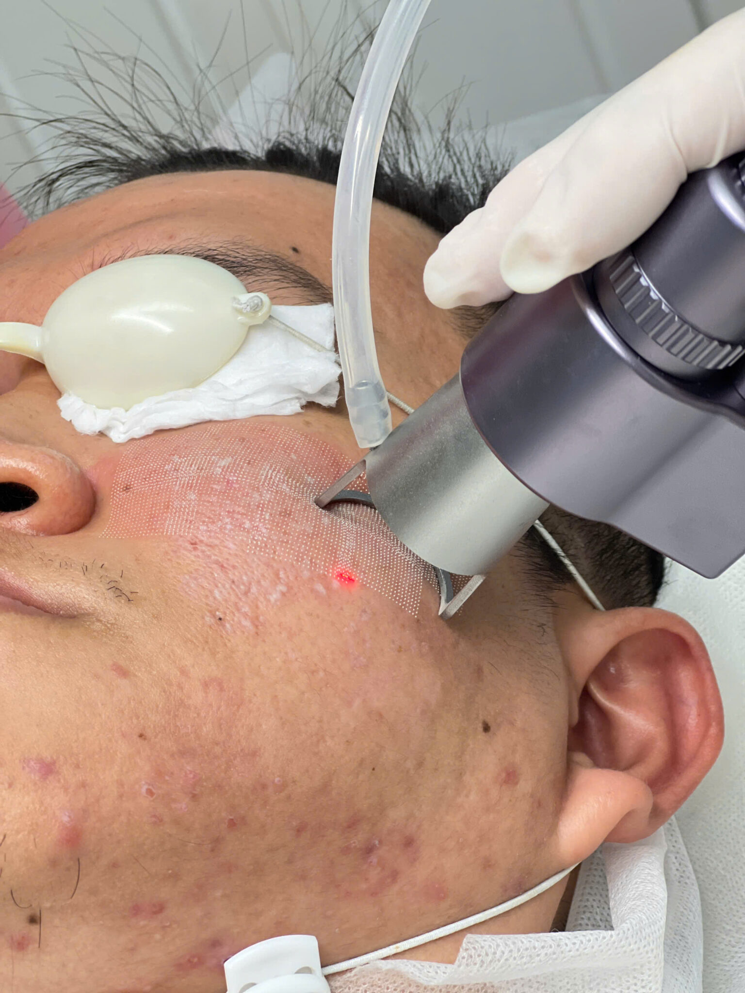Áp dụng công nghệ laser co2 fractional, phương pháp trị sẹo mụn đem lại hiệu quả vượt trội trong việc làm mờ vết sẹo do mụn, đem lại làn da mịn màng sau liệu trình trị sẹo mụn.