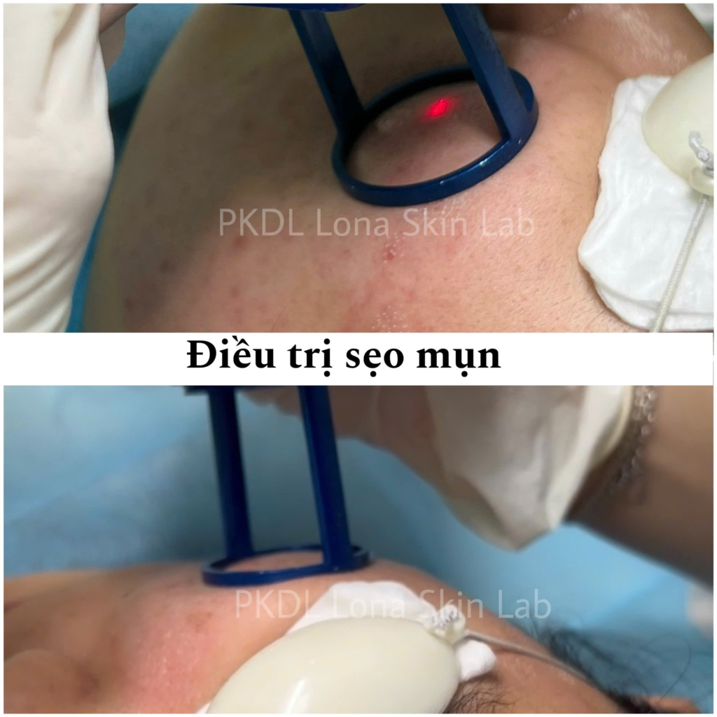 Trong liệu trình trị mụn Sóc Trăng hiện đại, spa trị mụn Sóc Trăng ứng dụng công nghệ laser giúp điều trị mụn hiệu quả Sóc Trăng, từ đó tăng cường dịch vụ trị mụn Sóc Trăng và nâng tầm thẩm mỹ viện trị mụn Sóc Trăng.