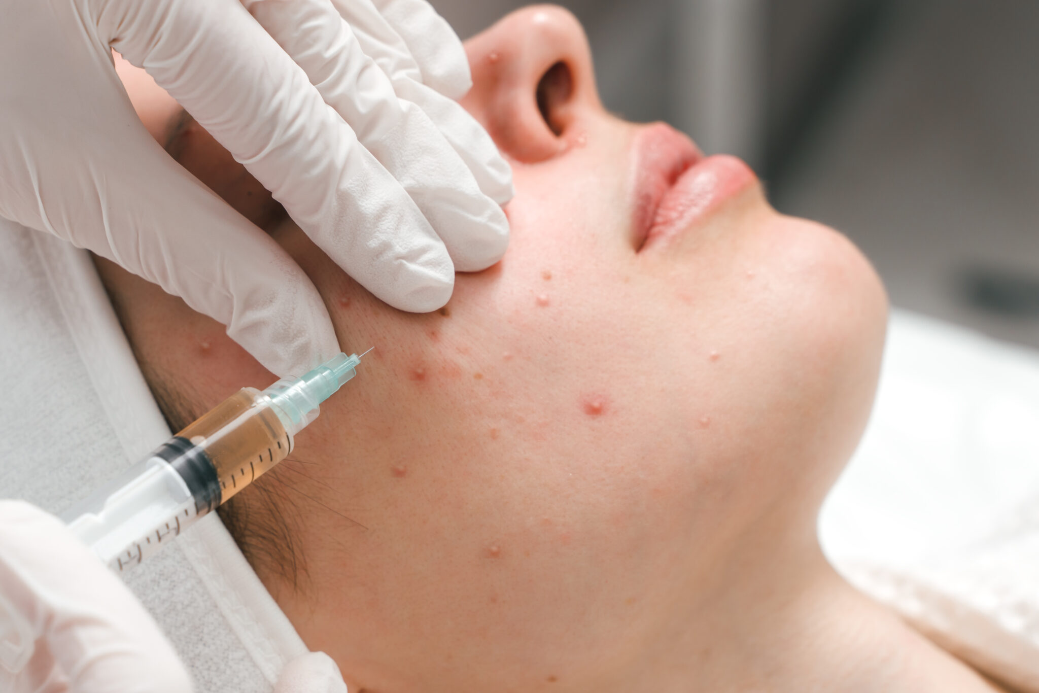 Quy trình tiêm meso Mỹ Tho hiện đại tại thẩm mỹ viện meso Mỹ Tho đảm bảo dịch vụ mesotherapy Mỹ Tho đạt chất lượng, được đánh giá tiêm meso Mỹ Tho từ chuyên gia với giá tiêm meso Mỹ Tho tối ưu.