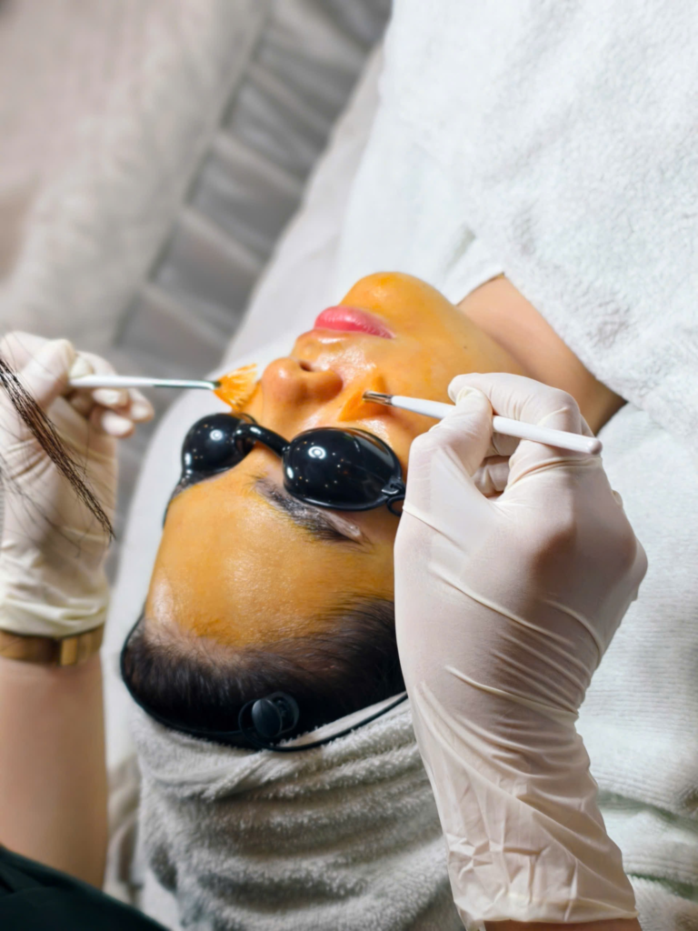 Bức ảnh này ghi dấu bước đột phá trong peel da trị mụn tại Cần Thơ khi Chuyên gia Lona áp dụng công nghệ Peel da Cần Thơ đột phá, mang lại hiệu quả trị mụn tại Cần Thơ và duy trì peel da an toàn.