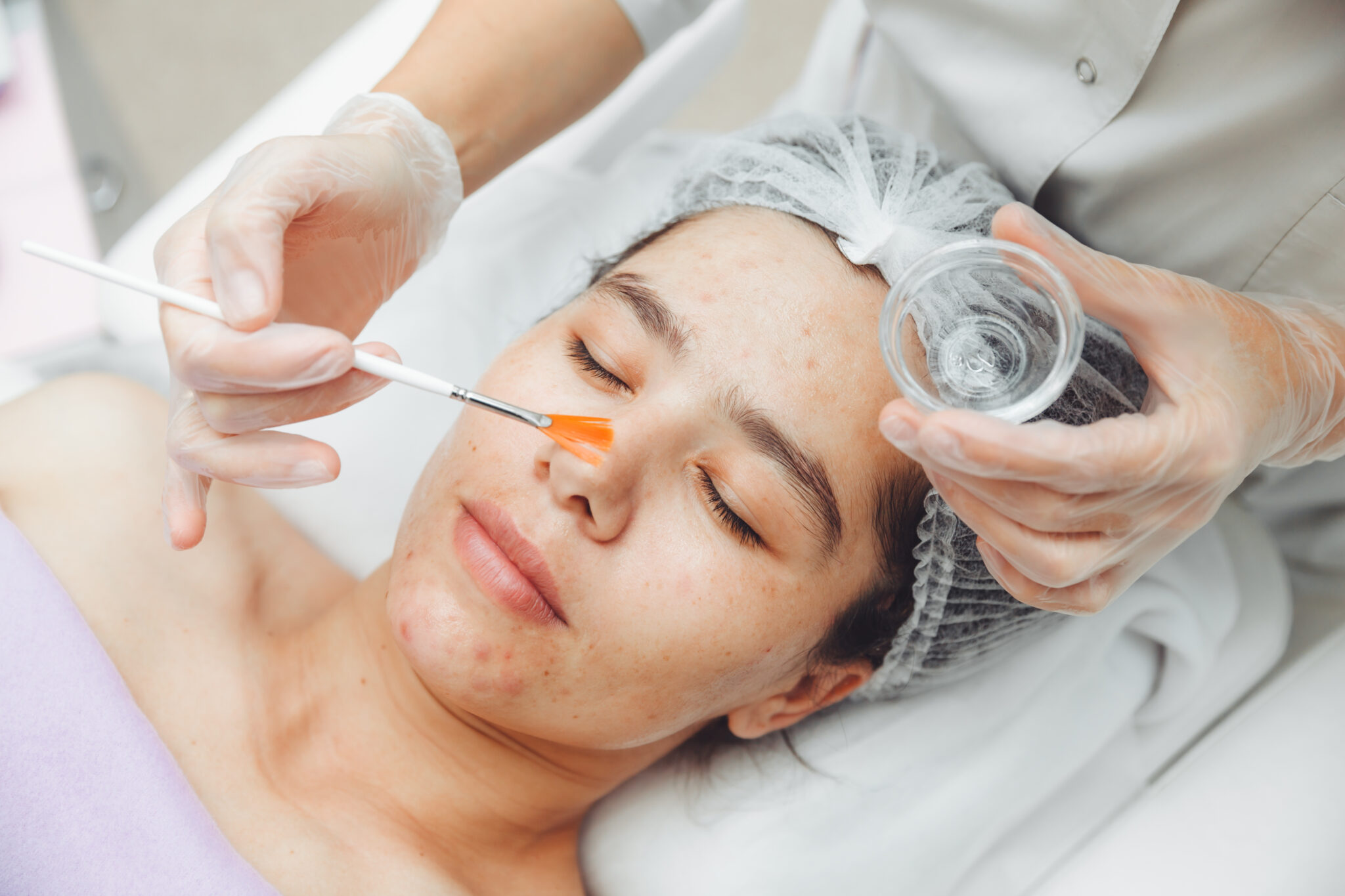 Trị nám da tại cần thơ sử dụng công nghệ peel trắng da giúp điều trị nám da tại cần thơ hiệu quả