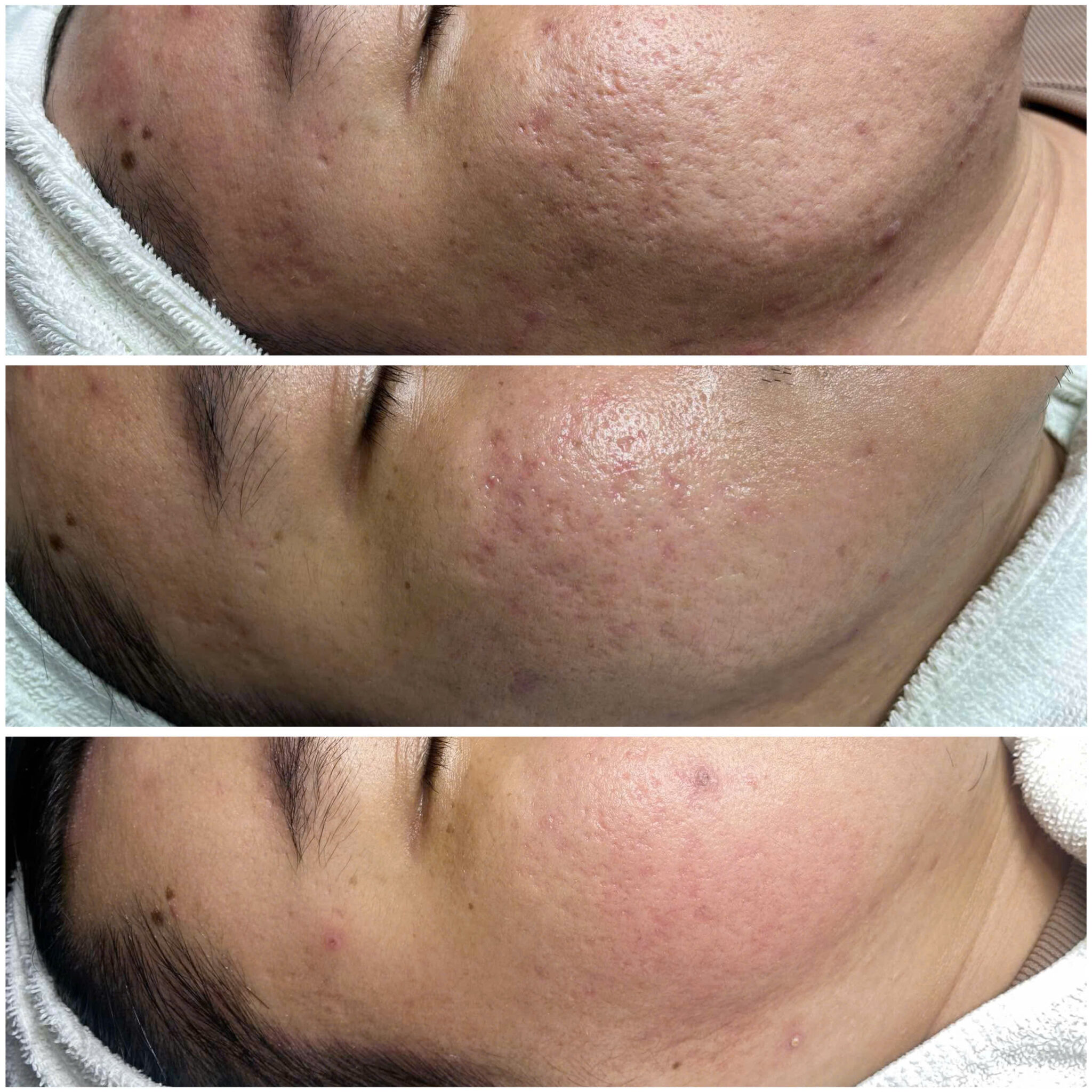 Quy trình mờ sẹo được thể hiện rõ qua hình ảnh, giúp mờ sẹo bằng liệu pháp điều trị tự nhiên và cải thiện kết cấu da.