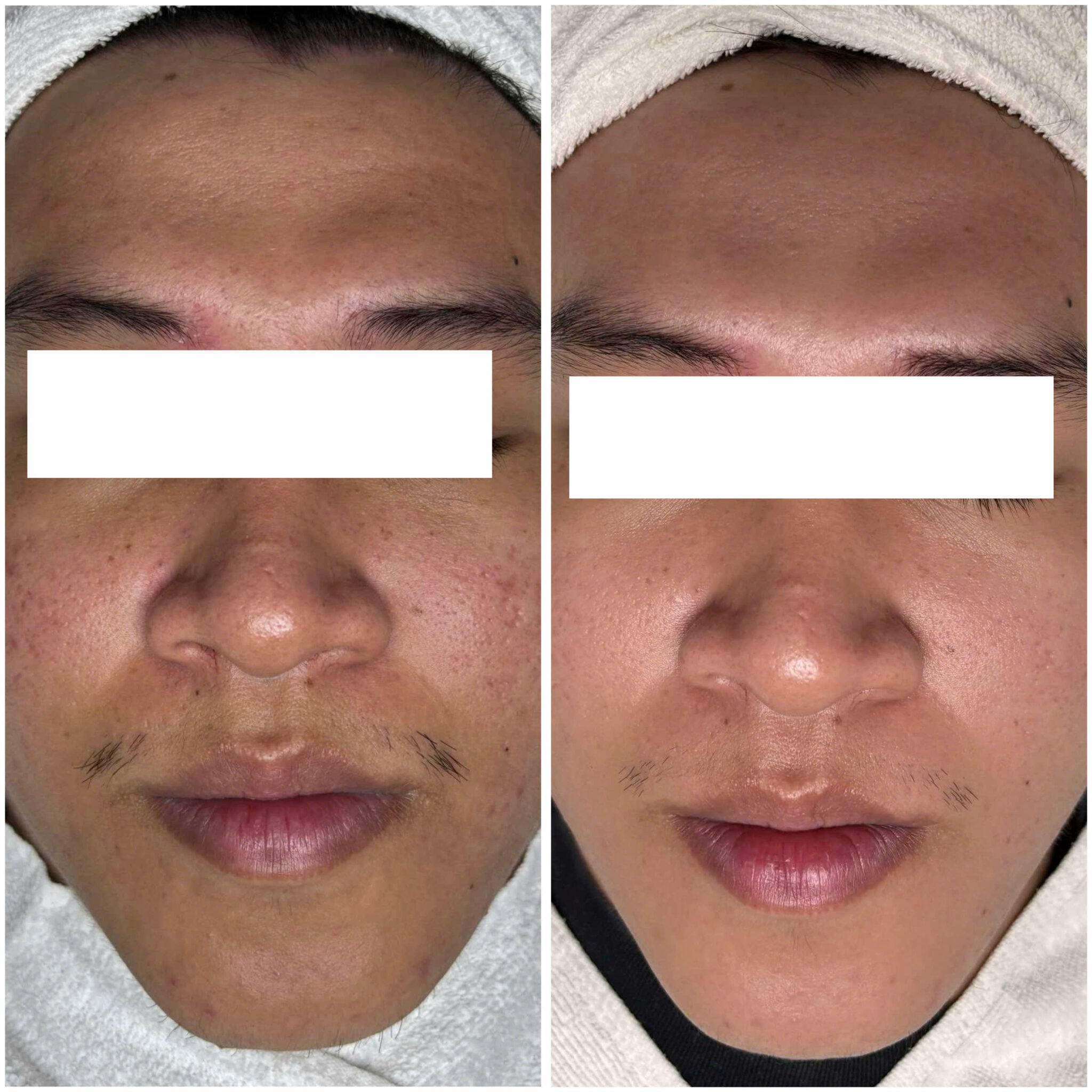 Quy trình điều trị mờ sẹo qua công nghệ tiên tiến giúp mờ sẹo, điều chỉnh sắc tố và tăng cường độ đàn hồi cho da.