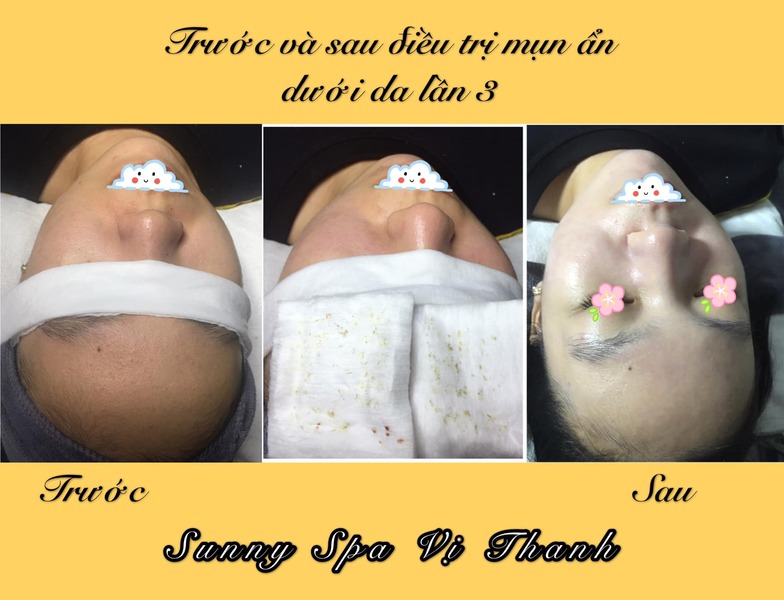 Sunny Spa Vị Thanh - spa trị mụn Hậu Giang