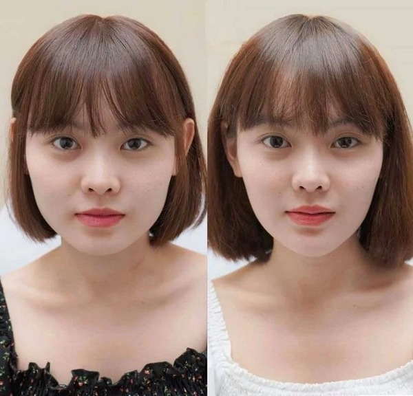 Trước và sau khi tiêm Botox