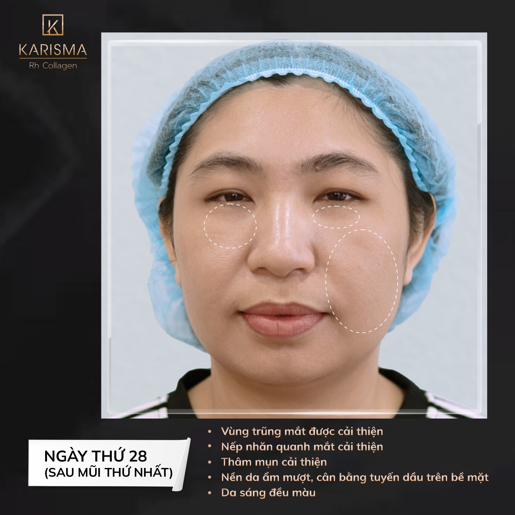 Karisma Rh Collagen ứng dụng hiệu quả trong xử lý trũng mắt