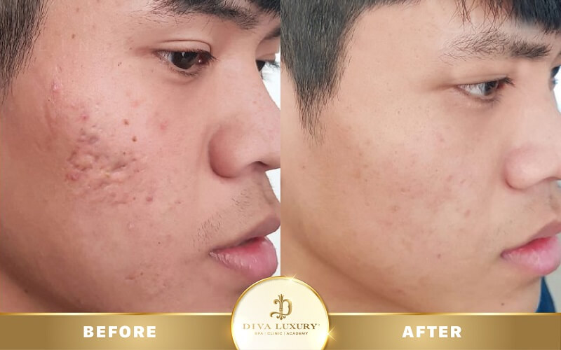 DIVA Luxury - Địa chỉ trị sẹo ở Long Xuyên chất lượng trị sẹo rỗ Long Xuyên tại DIVA Luxury, địa chỉ uy tín
