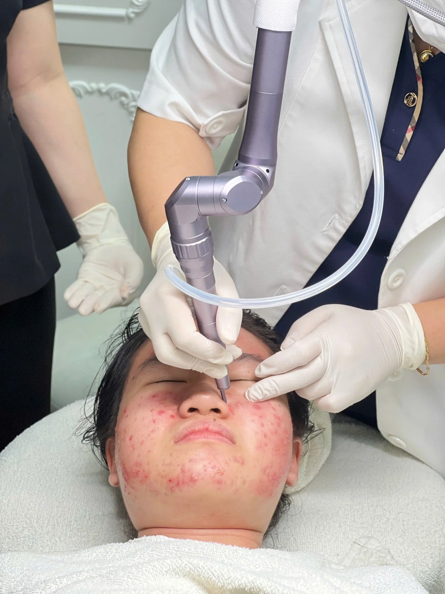 Trị mụn tại Phòng khám da liễu Lona Skin Lab