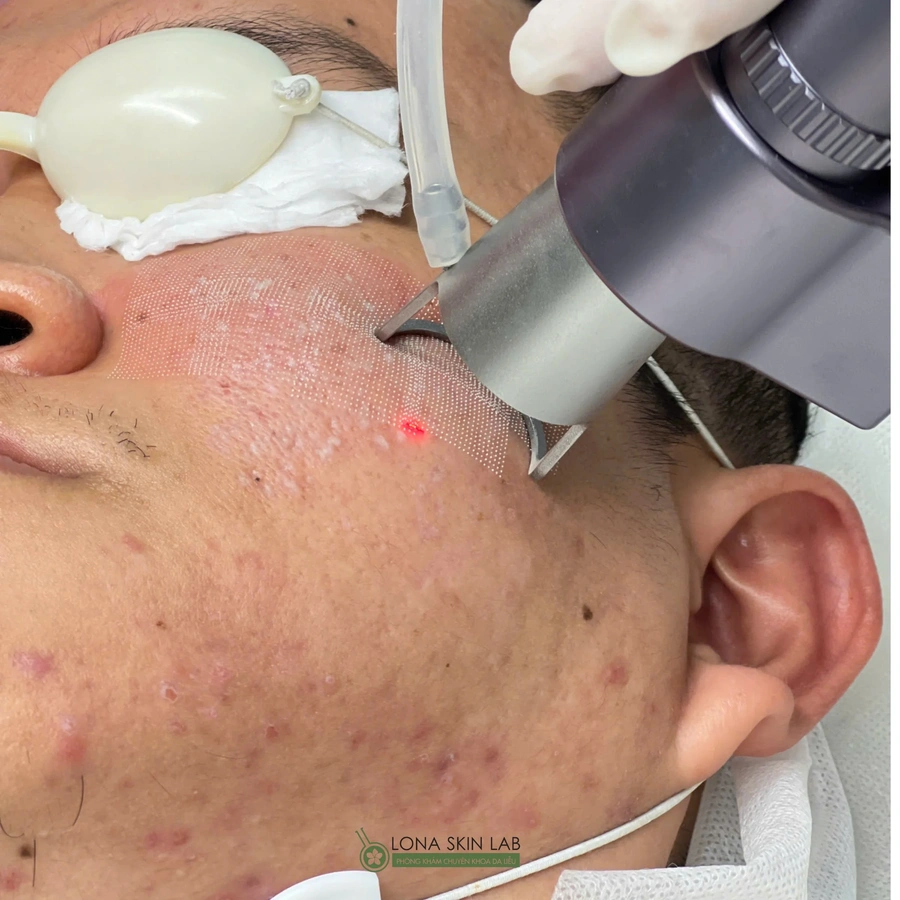 Trị sẹo tại Phòng khám da liễu Lona Skin Lab